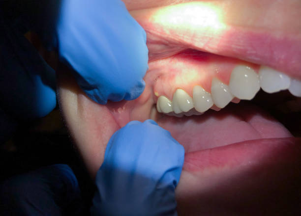 Best Emergency Wisdom Teeth Removal in Hasson Heights, PA